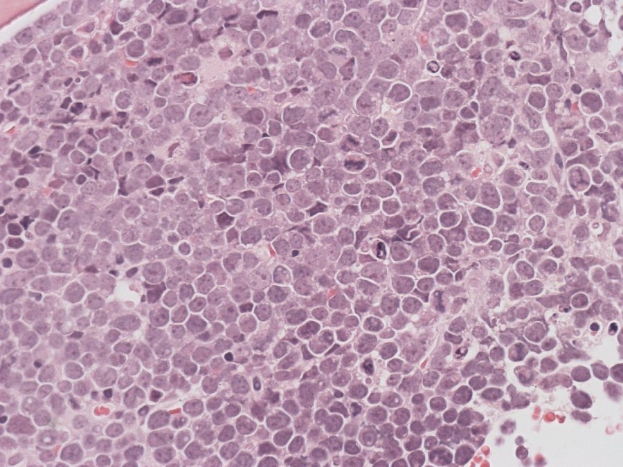 Burkitt Lymphoma – Haematological Malignancy Diagnostic Service