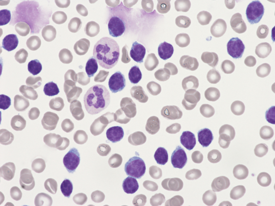 Chronic Lymphocytic Leukaemia – Haematological Malignancy Diagnostic ...