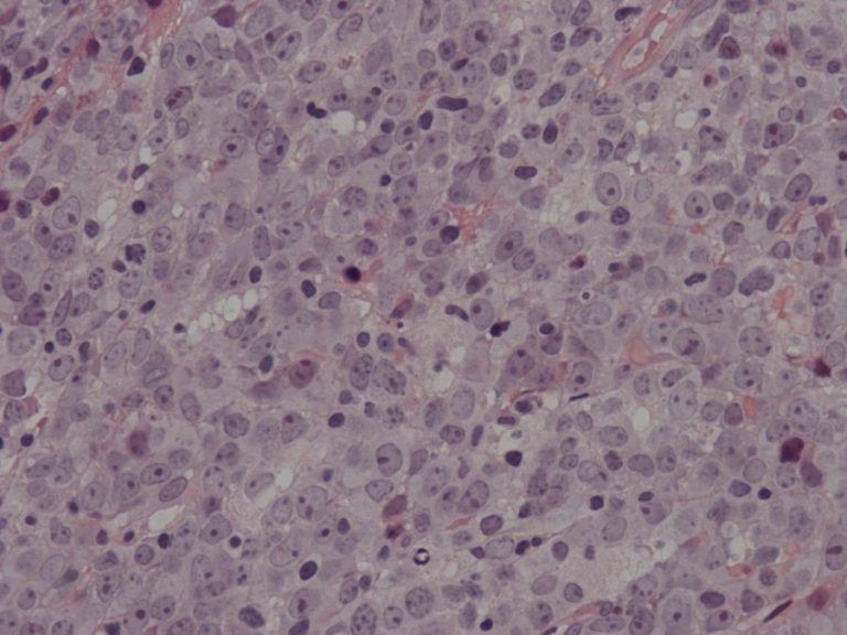 Diffuse Large B-cell Lymphoma – Haematological Malignancy Diagnostic ...