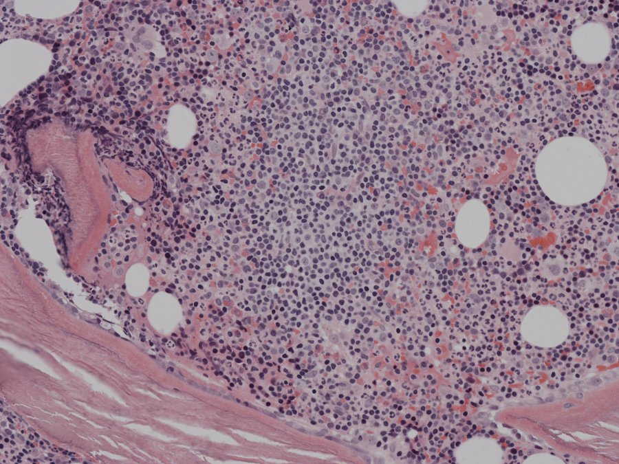 Systemic Marginal Zone Lymphoma – Haematological Malignancy Diagnostic ...